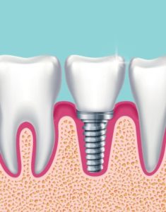 Dental implant fitting