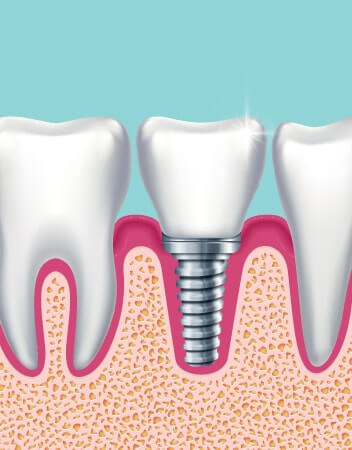 computer rendering side view of Dental Implant 