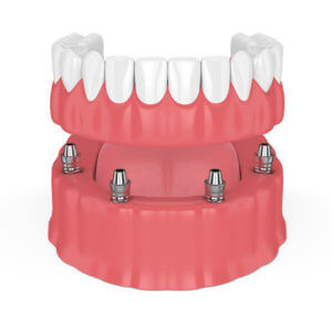 Removable full implant overdenture isolated over white background