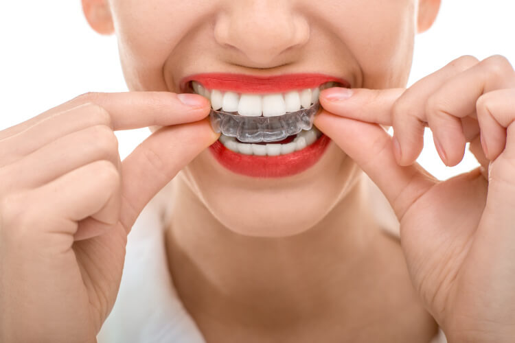 closeup of a woman with red lipstick taking out her clear aligners from Queensboro Plaza Dental Care