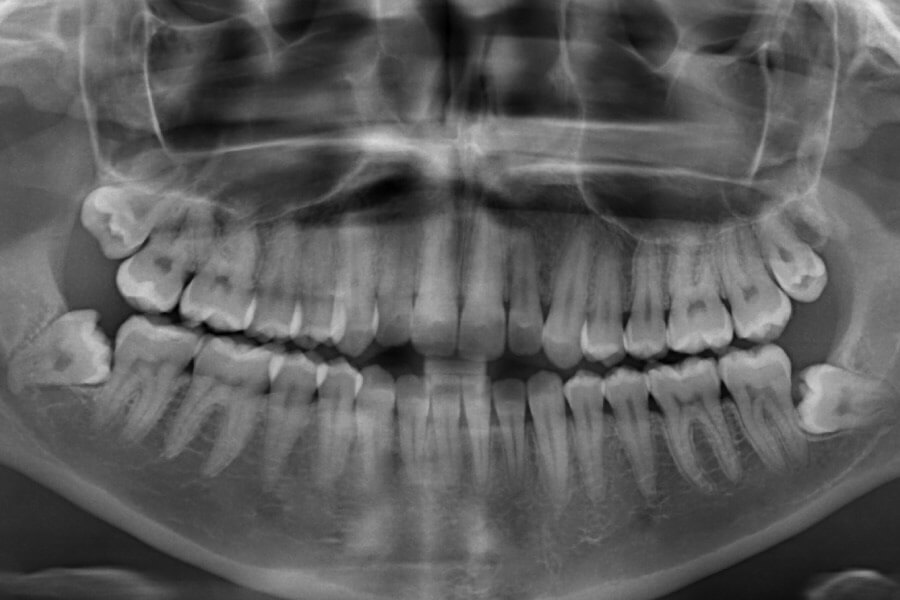 Panorex image showing wisdom teeth that need removal in Long Island City, NY
