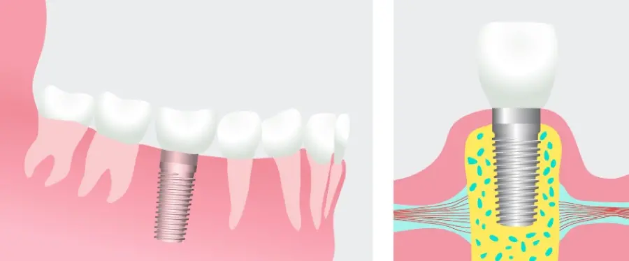 Model showing a dental implant in the lower jaw.
