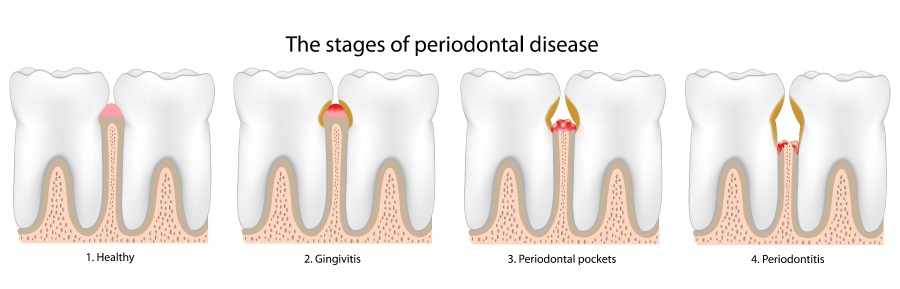 Graphic showing the stages of gum disease.