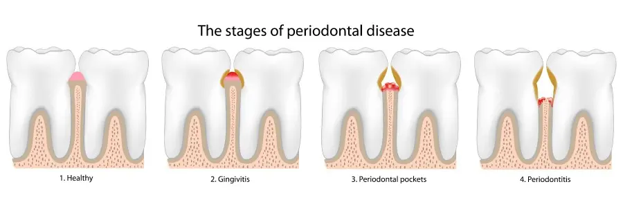Graphic showing the stages of gum disease.