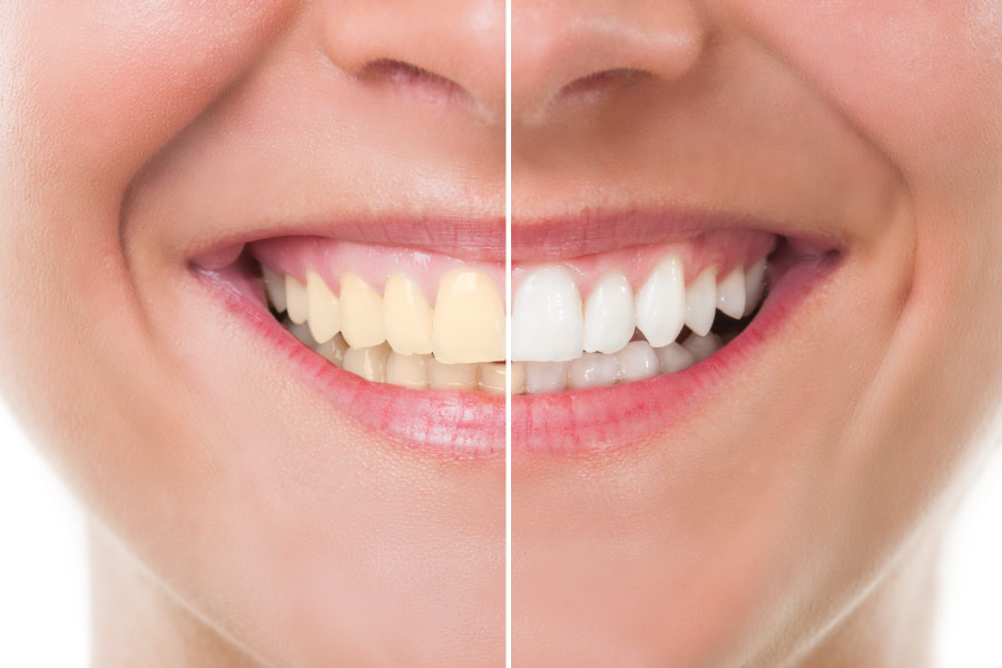 The bottom half of a woman's face with half the smile yellowed and half white, showing the difference that teeth whitening can make in a smile's appearance.