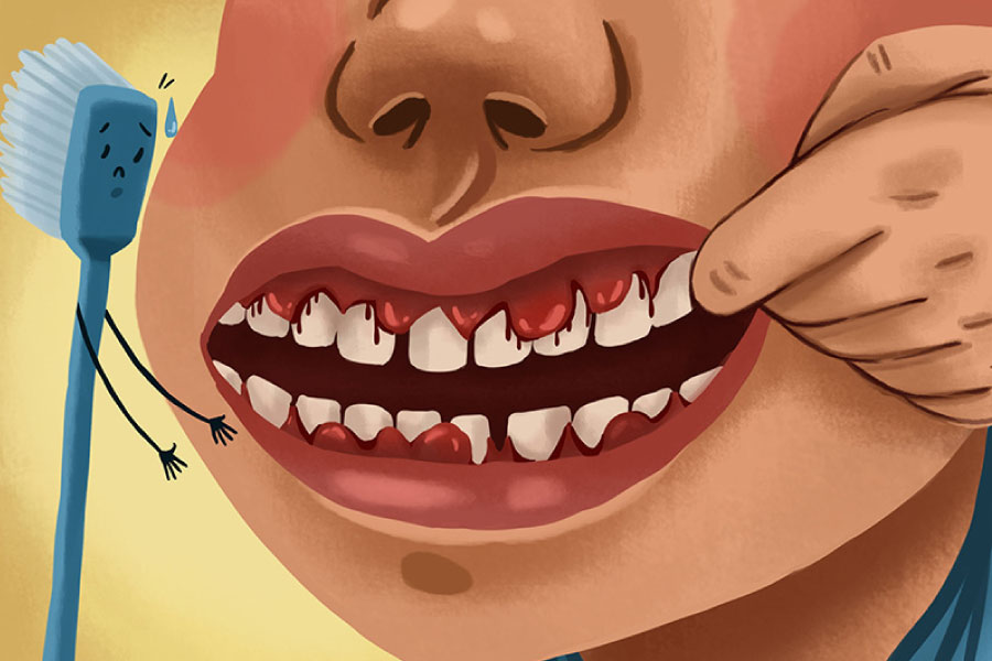 Cartoon showing bleeding gums which are a sign of gingivitis.