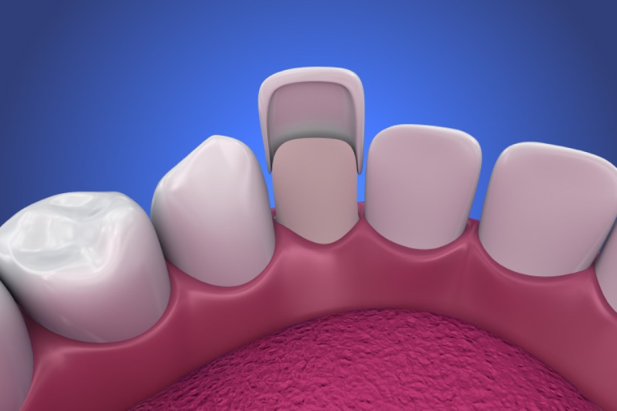 Model showing a dental veneer on a lower tooth.