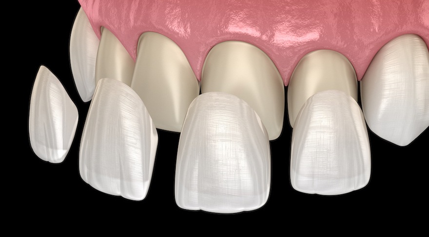 dental veneers, Veneer installation procedure over central incisor and lateral incisor. Medically accurate tooth 3D illustration