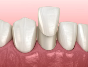 dental veneers, porcelain veneers, Mandibular Veneer installation procedure over lateral incisor. Medically accurate tooth 3D illustration