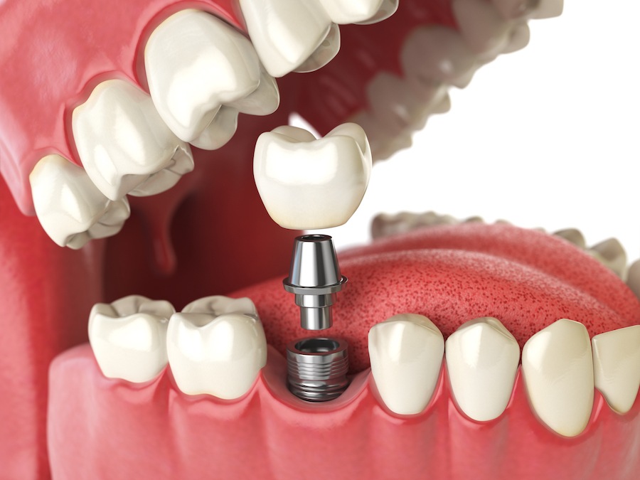 medically accurate dental implant, loose dental implant