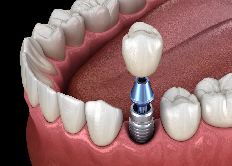 dental crown options, dental crown, dental crowns, restorative dentistry, cracked tooth, broken tooth, chipped tooth, dental implant