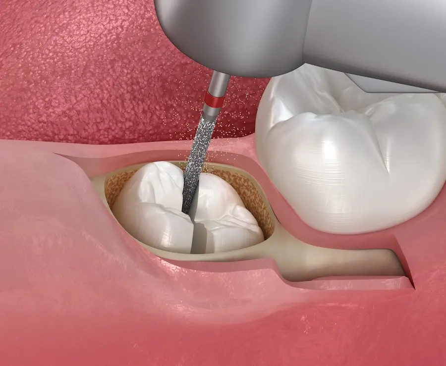 What is a Surgical Tooth Extraction? | Queensboro Plaza Dental Care