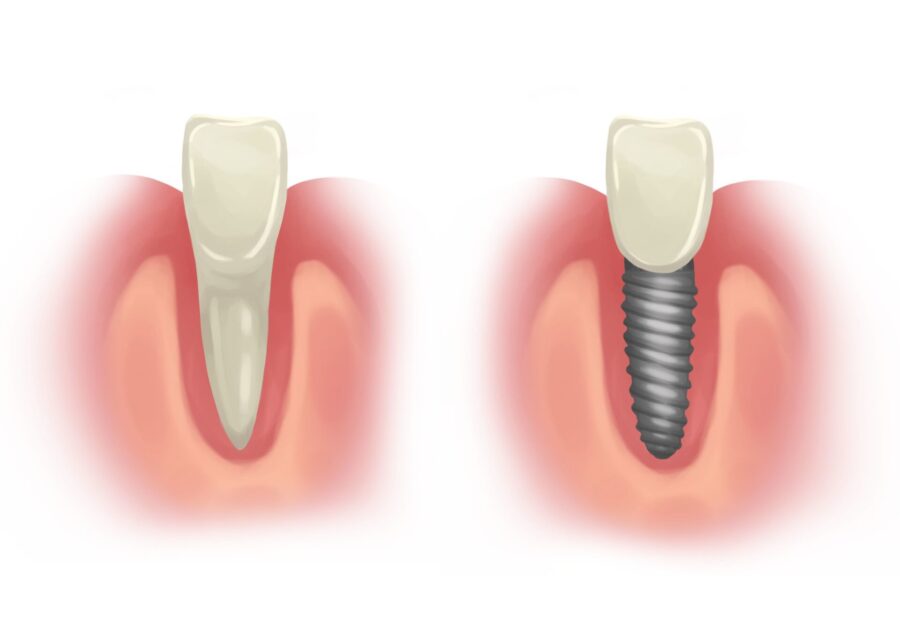 dental implant vs natural tooth, osseointegration of dental implant with jaw bone