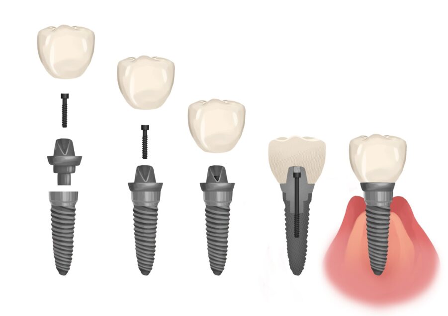 image of parts of dental implant including the dental crown