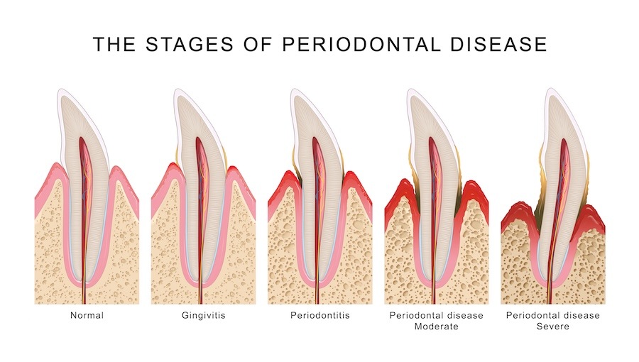 stages of gum disease, gingivitis, periodontal disease