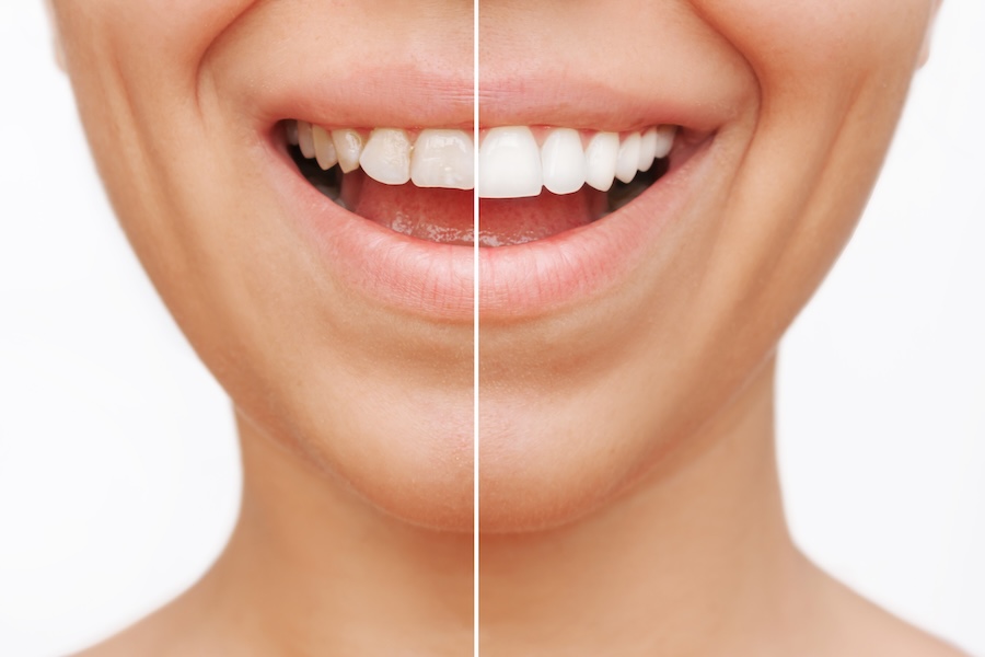 veneers can fix slightly crooked, chipped, or broken teeth