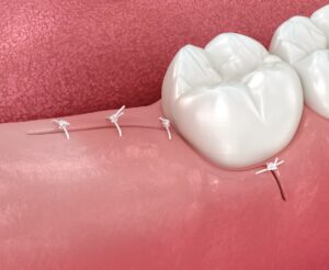 wisdom teeth stitches after wisdom teeth extraction