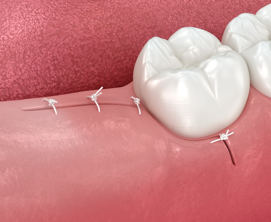 wisdom teeth stitches after wisdom teeth extraction