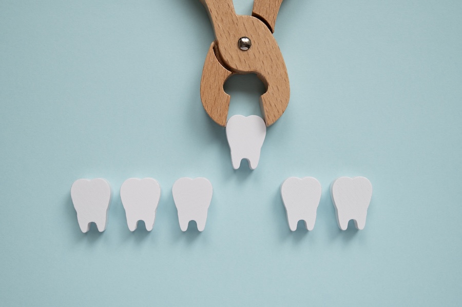 image of tooth extraction for recovery after surgical tooth extraction