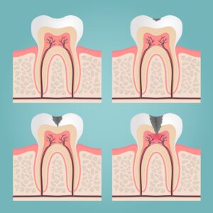 early signs of tooth decay with occlusal decay spreading through a molar