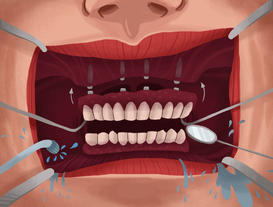 image of implant supported dentures in the mouth during an exam