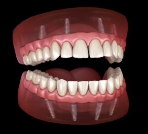 implant supported dentures vs traditional dentures