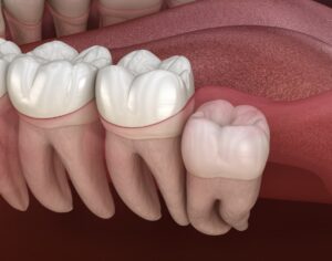 vertically impacted wisdom teeth that needs surgical extraction