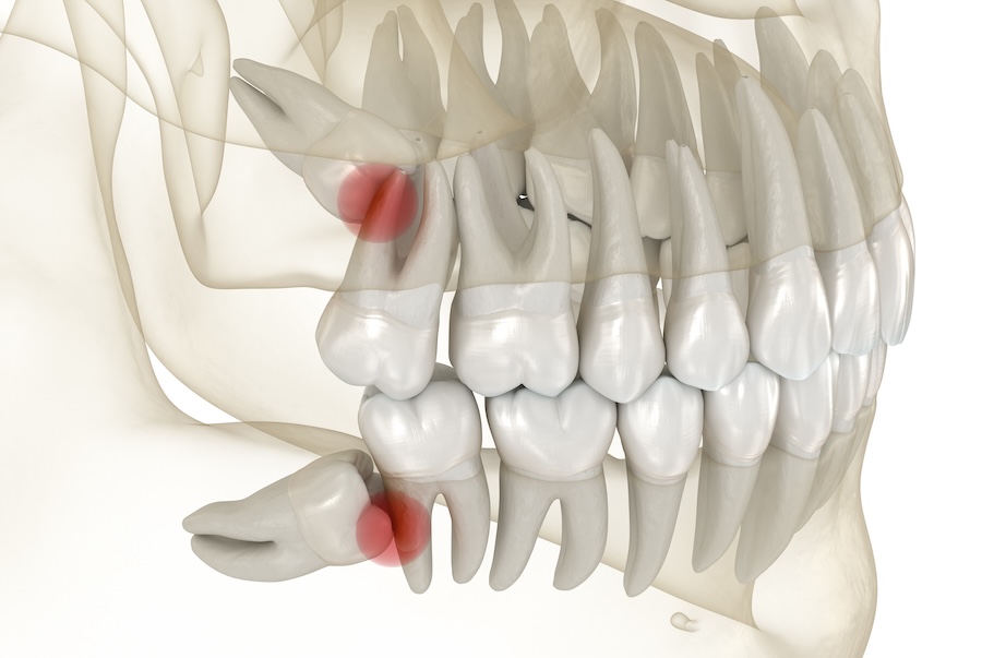 impacted wisdom teeth