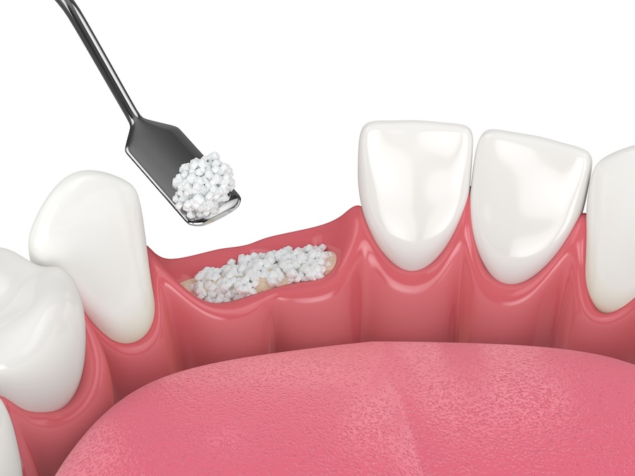 bone grafting bone graft healing