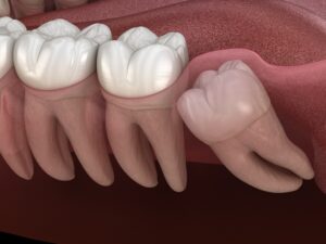 complex wisdom teeth extraction, impacted wisdom tooth