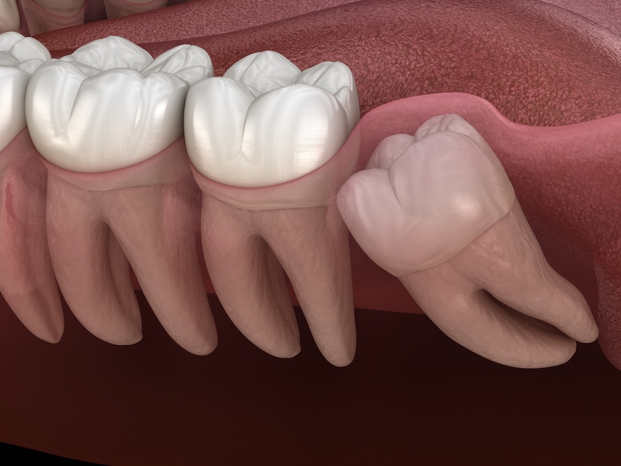 complex wisdom teeth extraction, impacted wisdom tooth
